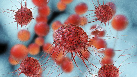 celije karcinoma