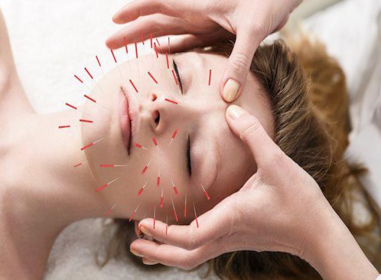 akupunktura za liječenje artroze